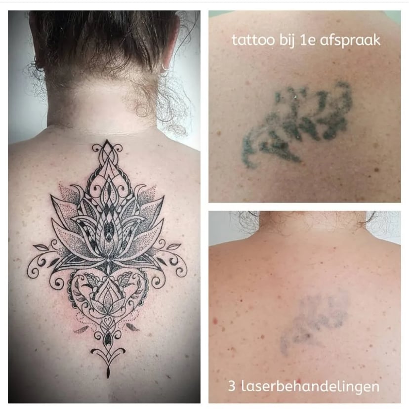 Cover up na laserbehandeling 2