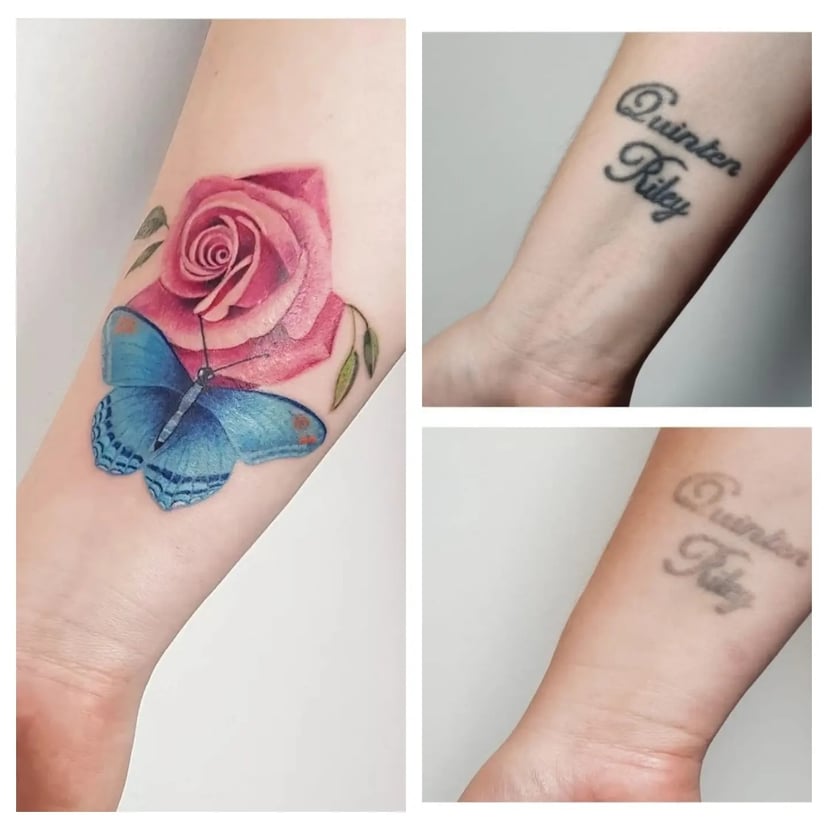 Laserbehandeling en cover- up 1